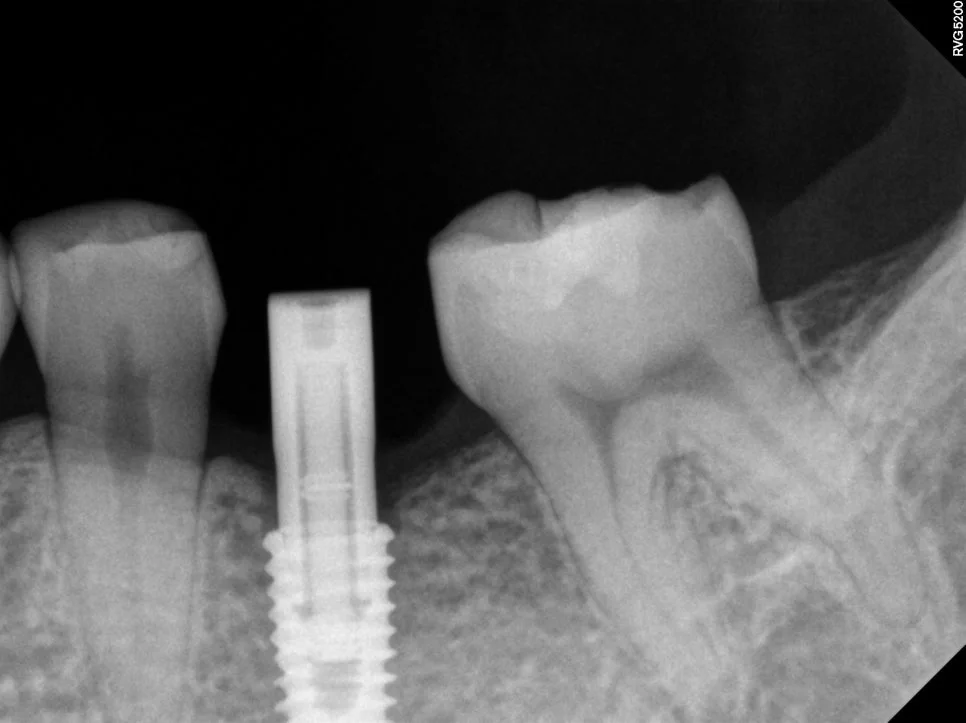양쪽 임플란트 식립 깊이 확인 X선