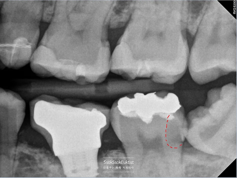 교익 방사선 사랑니 인접 충치 빨간 표시