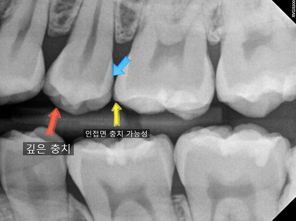 교익 방사선 깊은 충치 인접면 충치 가능성 표시
