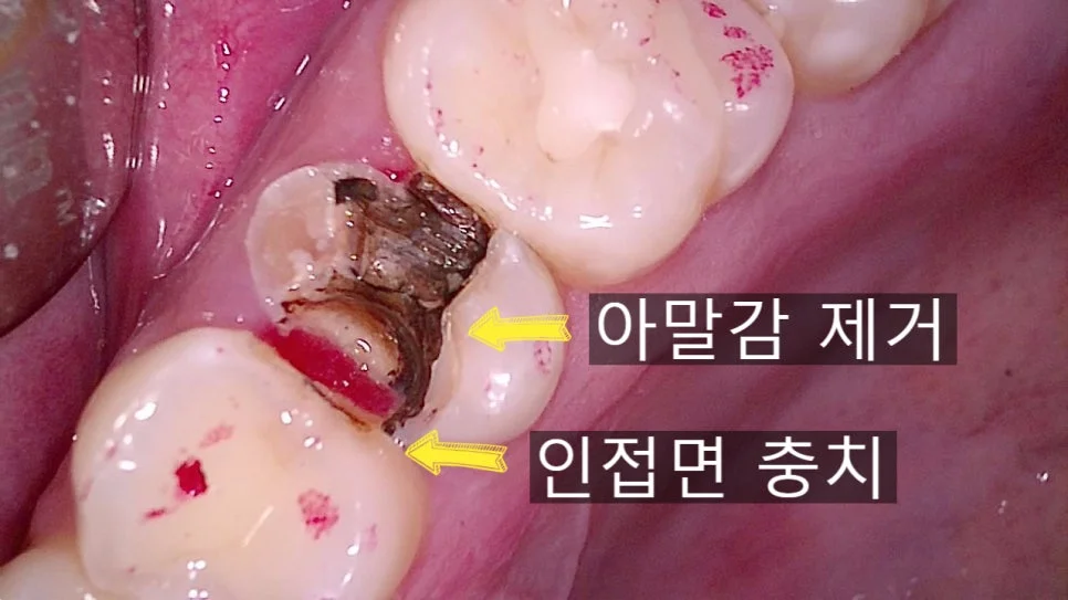 교익 방사선 하악 인접면 충치 진단