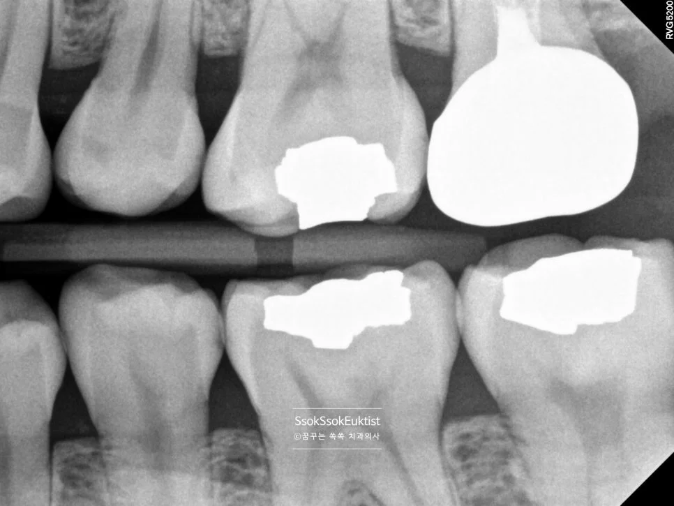 교익 방사선 사진 치아 사이 충치 진단 왼쪽 X-ray