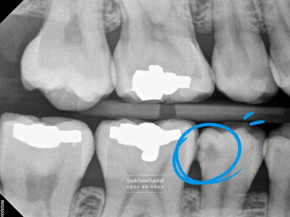 교익 방사선 사진 치아 사이 충치 진단 오른쪽 X-ray