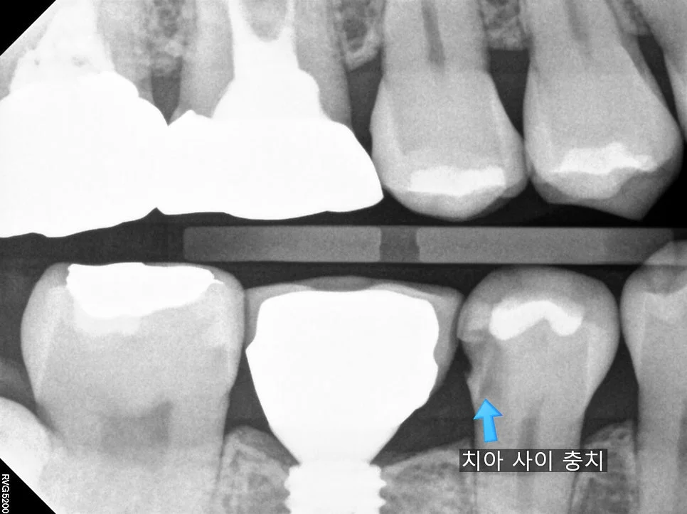 교익 방사선 사진 오른쪽 임플란트 인접 치아 사이 충치 확인