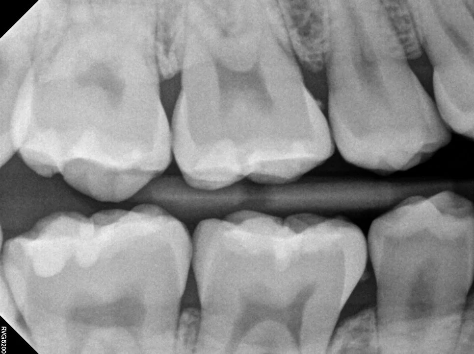 교익 방사선 치아 사이 충치 확인
