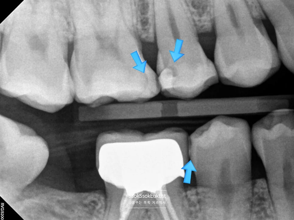 하악 교익 방사선 사진 충치 진단