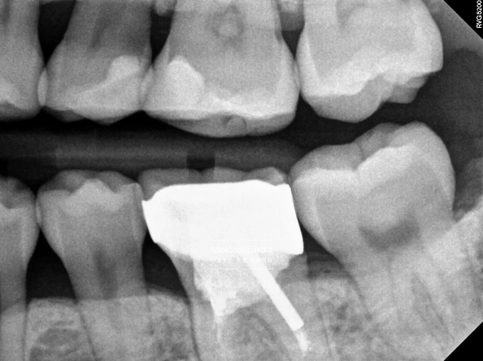 하악 교익 방사선 사진 충치 없음