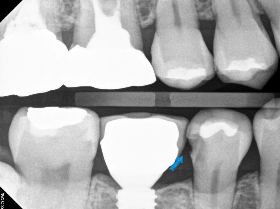 오른쪽 아래 인레이 치료 부위 교익 방사선 상세