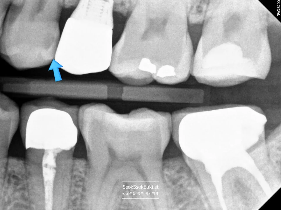 상악 교익 방사선 사진 충치 진단