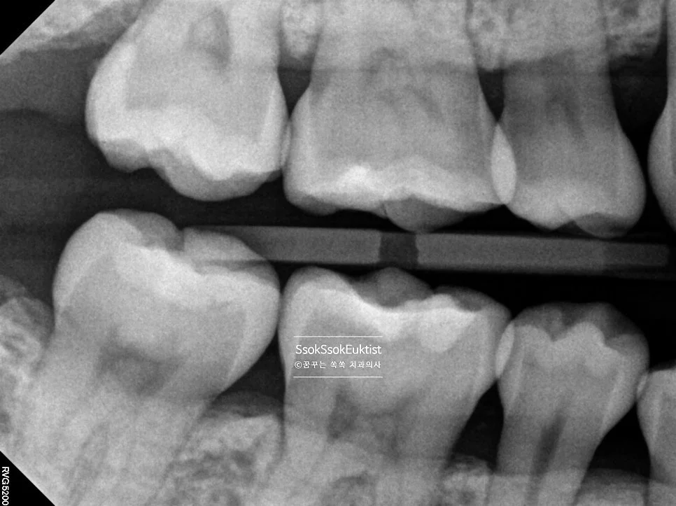 상악 교익 방사선 사진 충치 없음