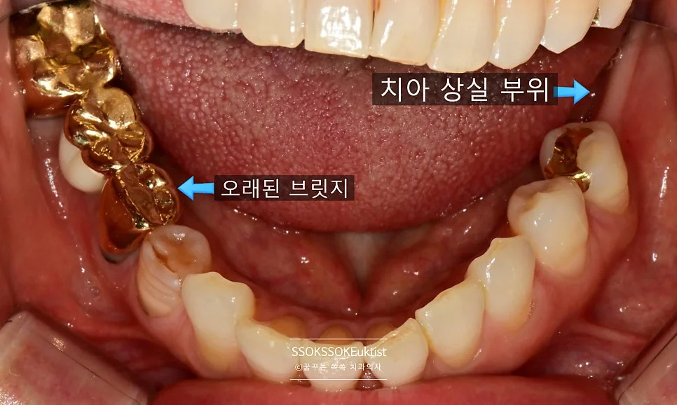 부러진 앞니 시술 전 하악 정면 브릿지 상태