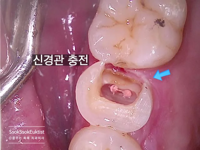 신경관 기계적 확대 및 성형 단계 임상 사진