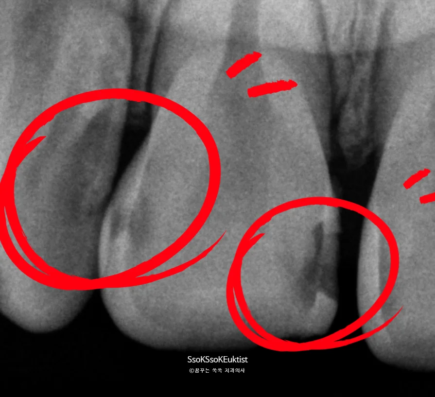 설측 충치 제거 과정 임상 사진