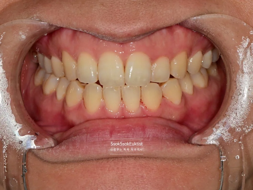 착색 제거 케이스1 후 깨끗한 치아