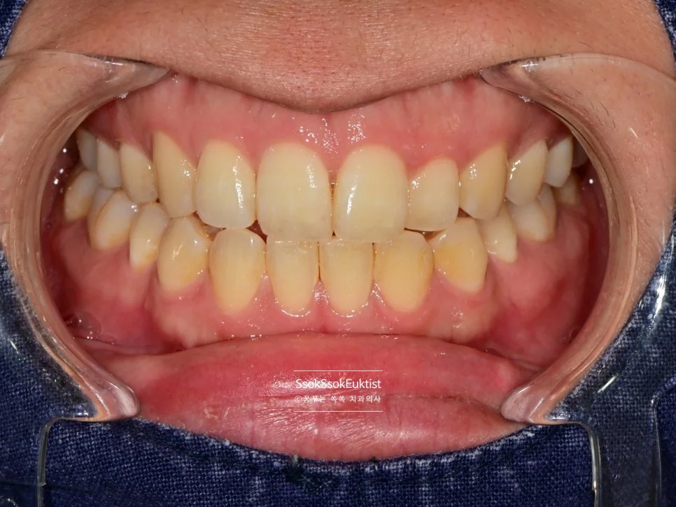 착색 제거 케이스1 전 노란 얼룩