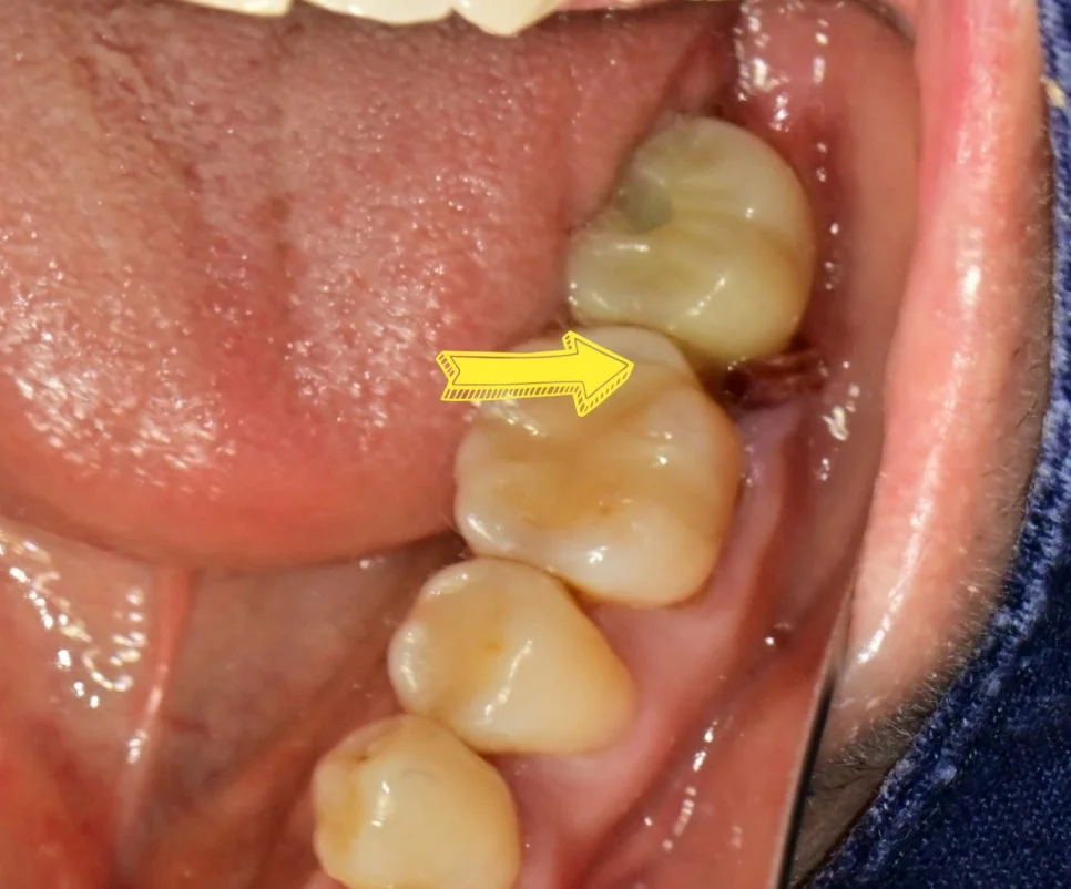 임플란트 음식물 끼임 잇몸 부음 사진
