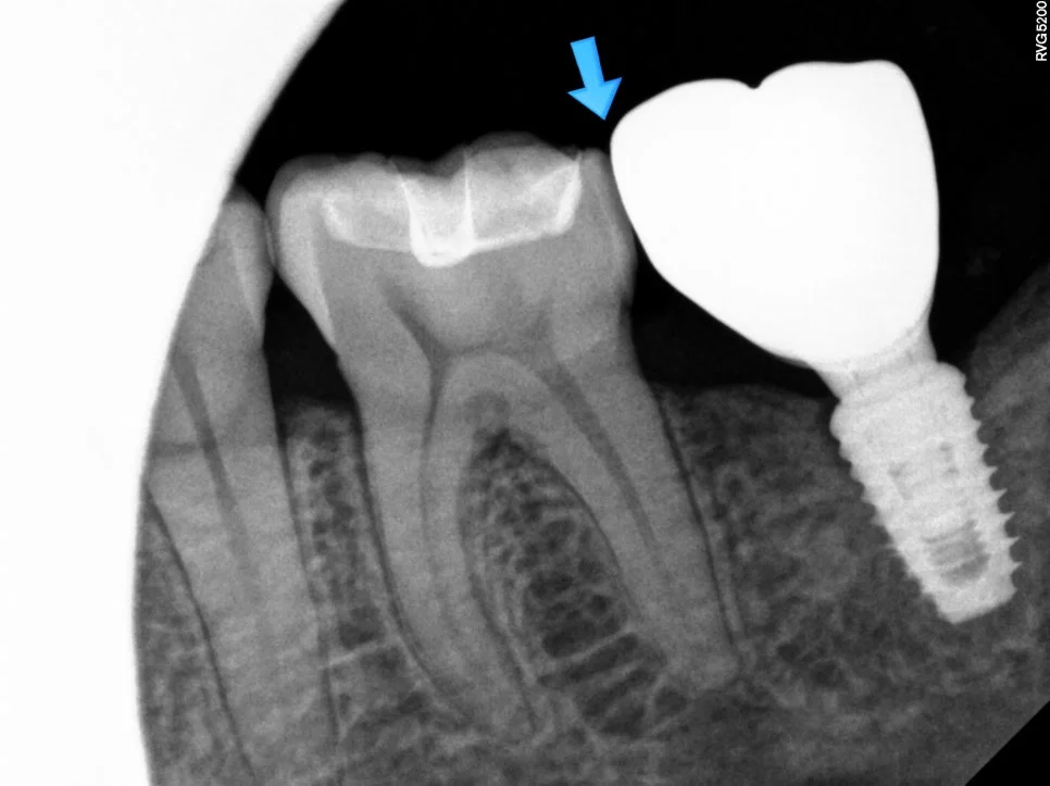 치료 후 잇몸 회복 결과 사진