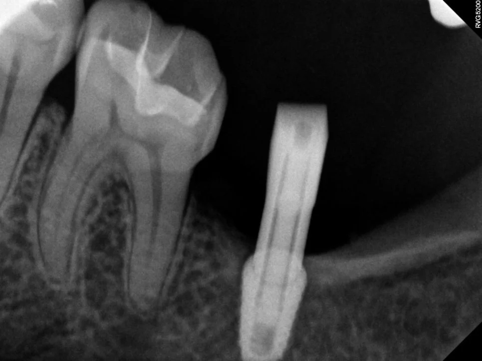 임플란트 기둥 크라운 재제작 과정