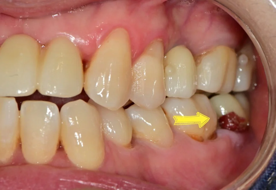 임플란트와 인접 치아 사이 틈새