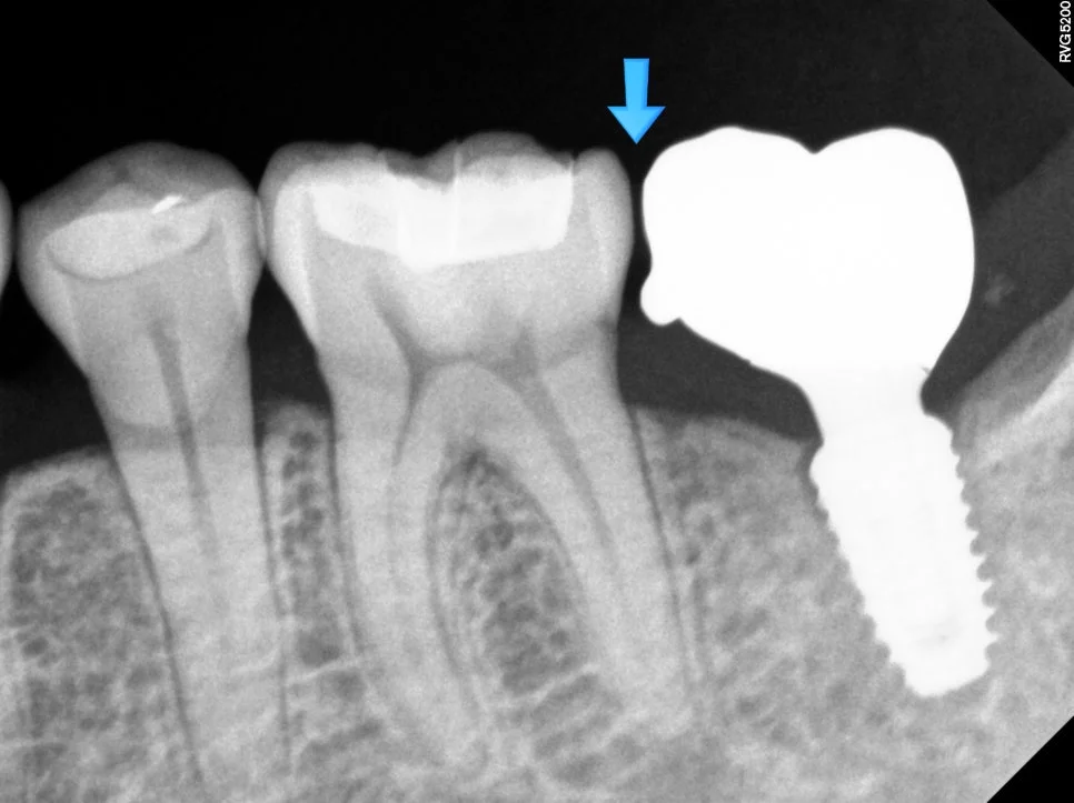 임플란트 틈새 진단 방사선 사진