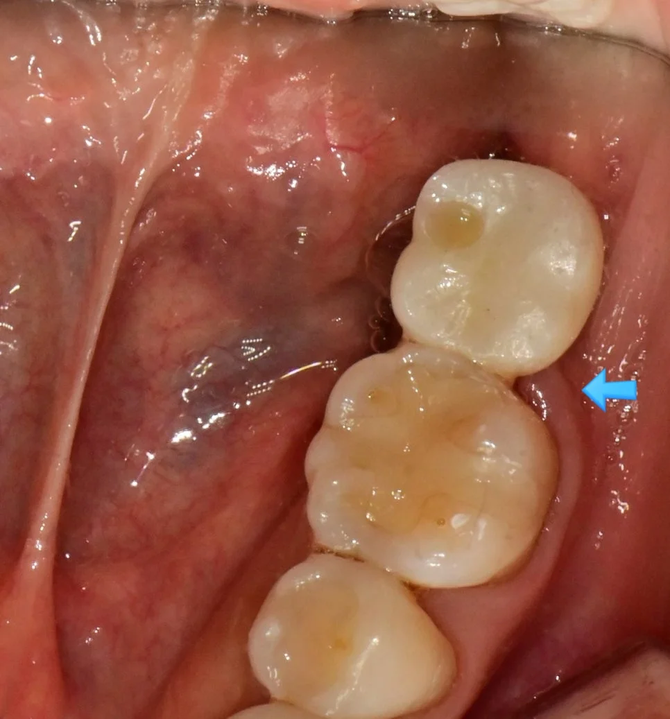 재제작 크라운 적합 확인 사진