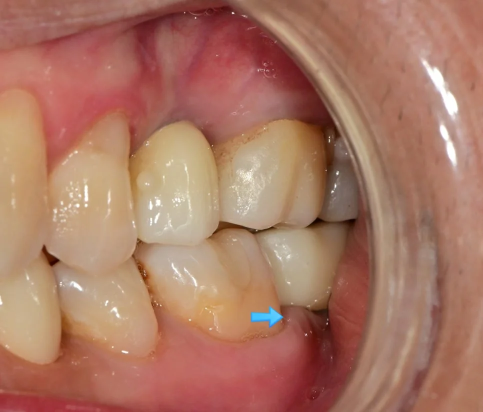 긴밀한 사이 틈 복원 완료 사진