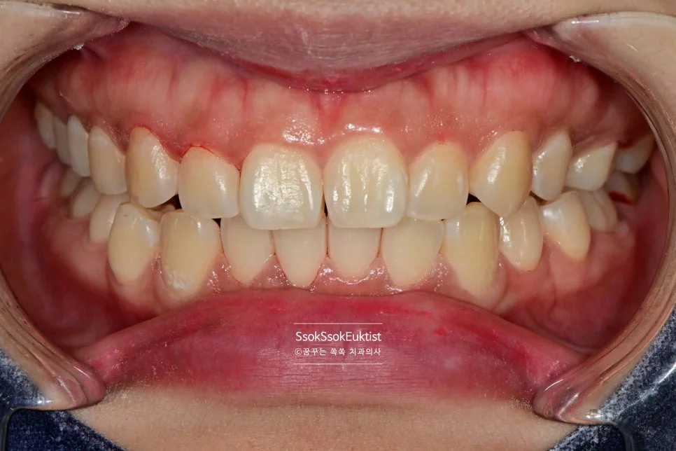 착색 제거 케이스2 후 깨끗한 치아