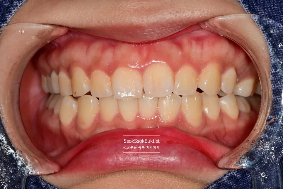 착색 제거 케이스2 전 갈색 착색