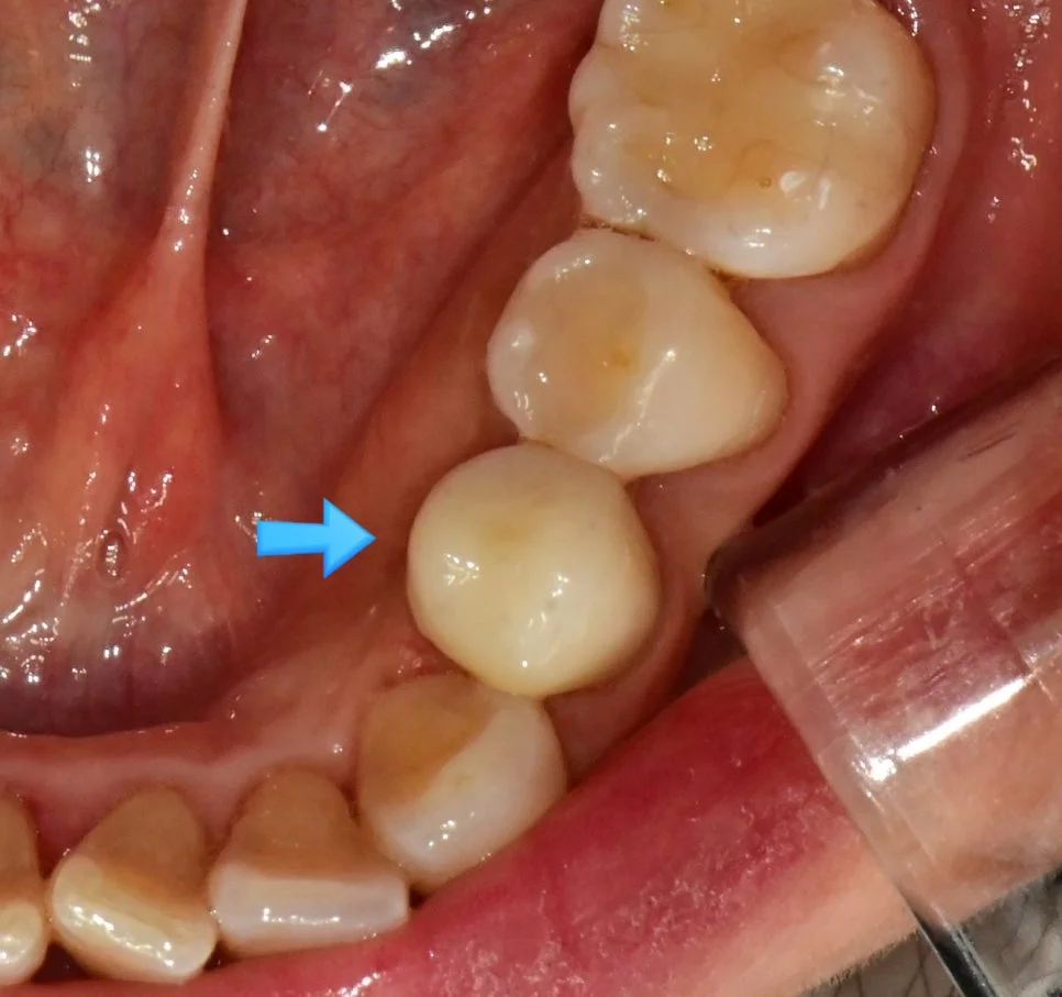 크라운 접착 최종 결과