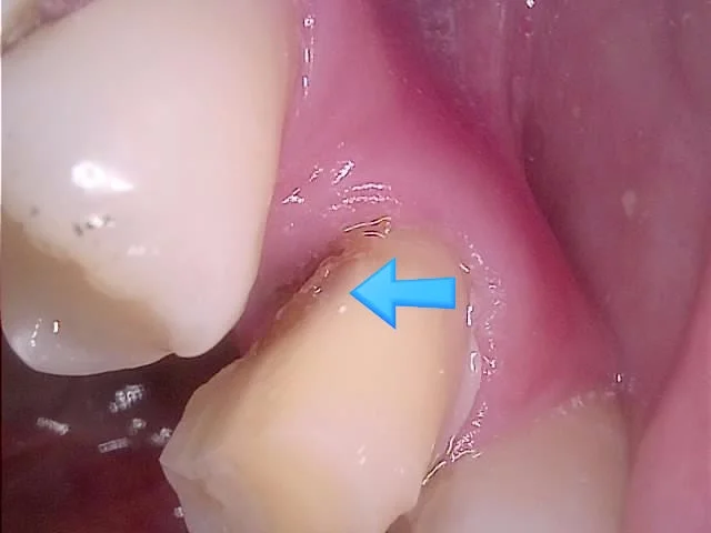 깊은 충치 제거 과정 근접 사진