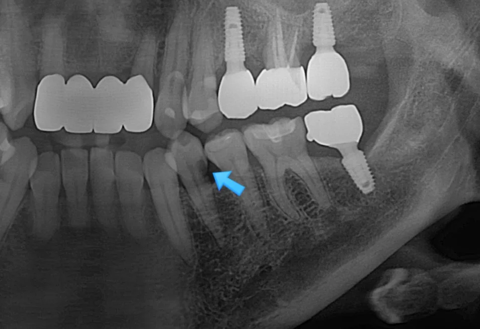 뿌리 충치 진단 임상 사진