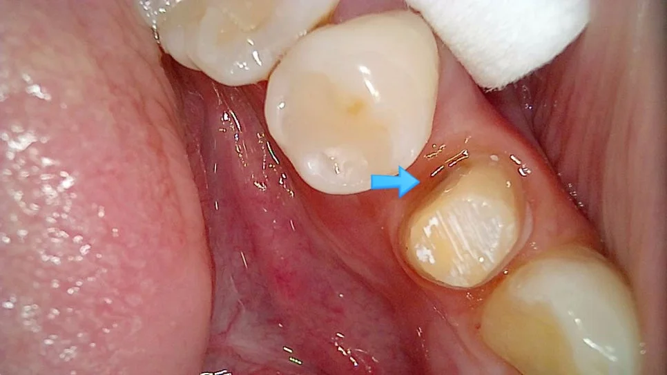 본뜨기 전 정리된 치아 형태