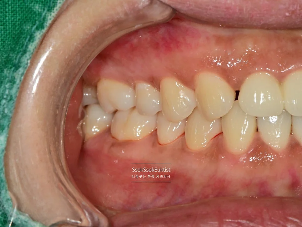 착색 제거 케이스3 후 좌측 사진