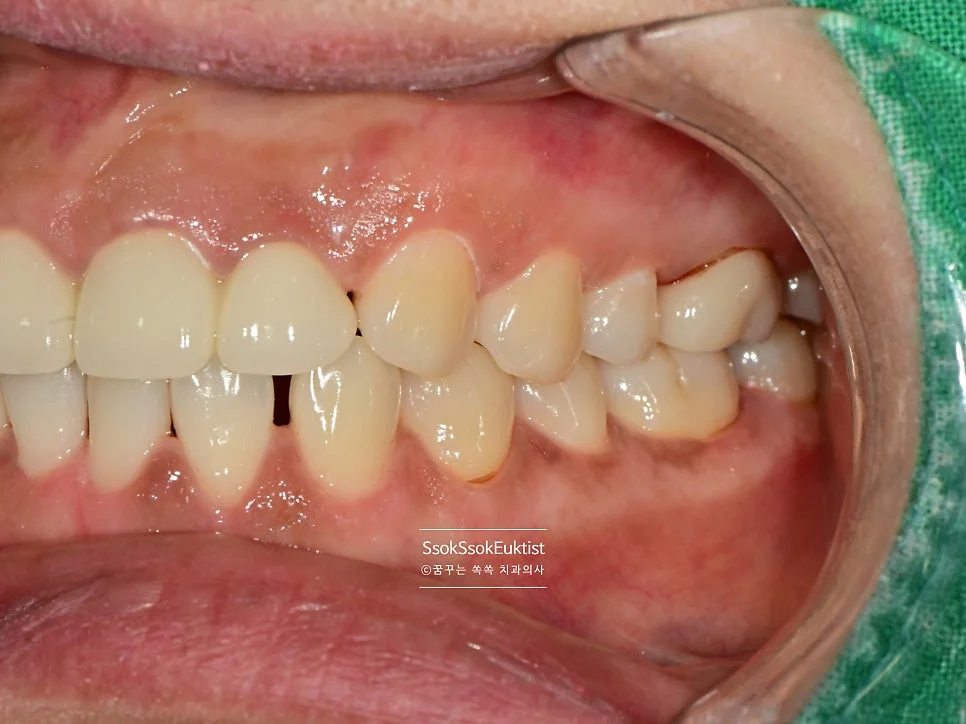 착색 제거 케이스3 후 우측 사진