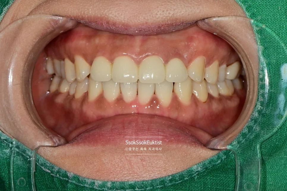 착색 제거 케이스3 후 깨끗한 치아