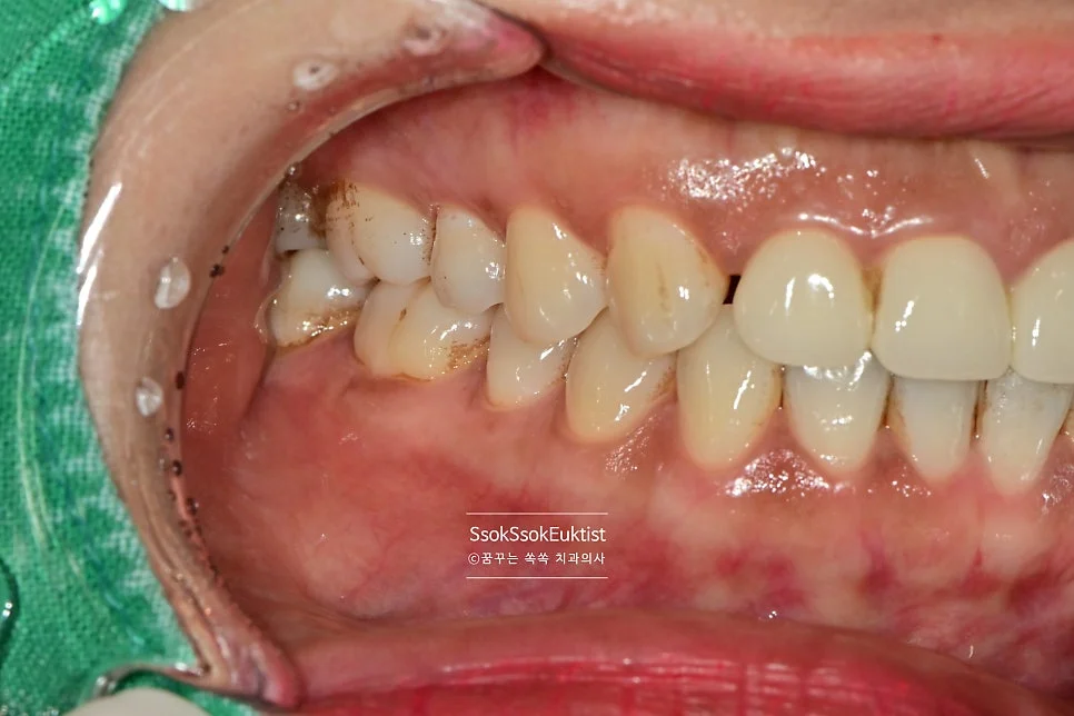 분사형 스케일러 착색 제거 과정 1