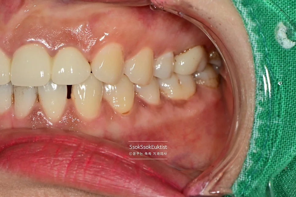 분사형 스케일러 착색 제거 과정 2