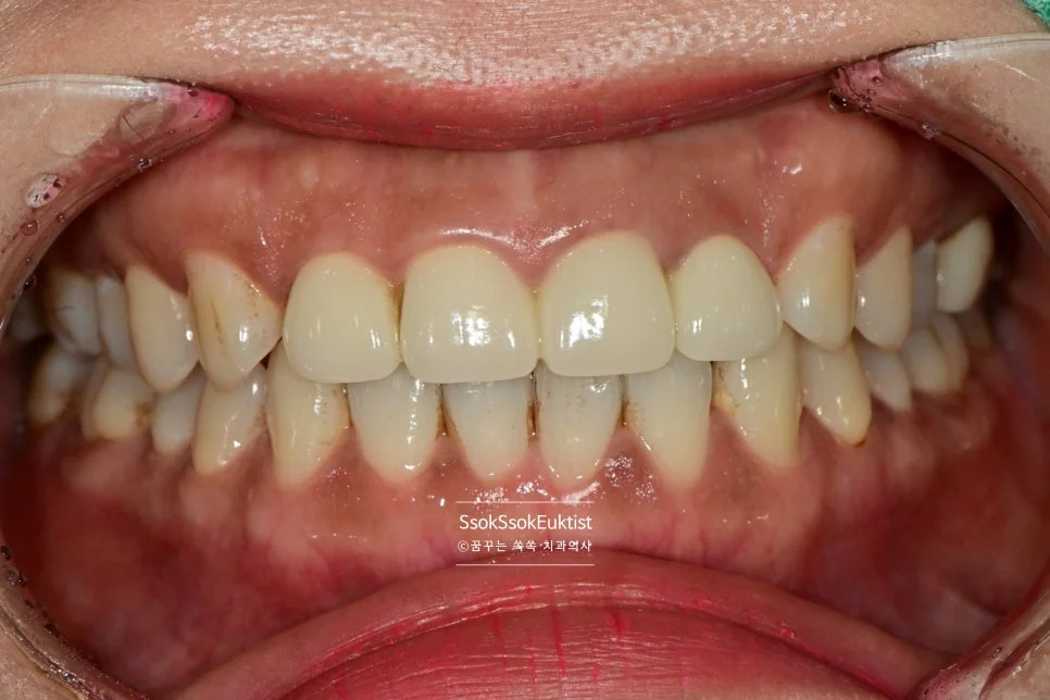 착색 제거 케이스3 전 검은 착색