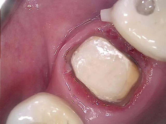 크라운 치료를 위해 치아를 다듬은 모습