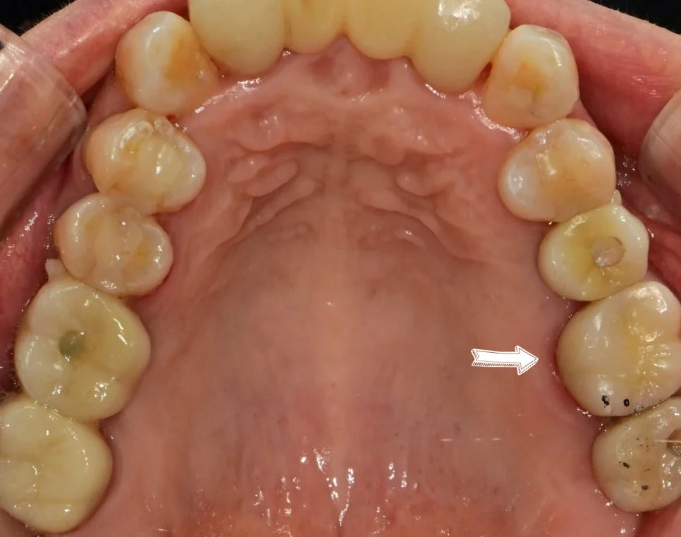 새 보철물 접착 음식물 끼임 해결