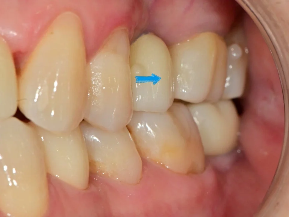 새 크라운 적합 상태 확인