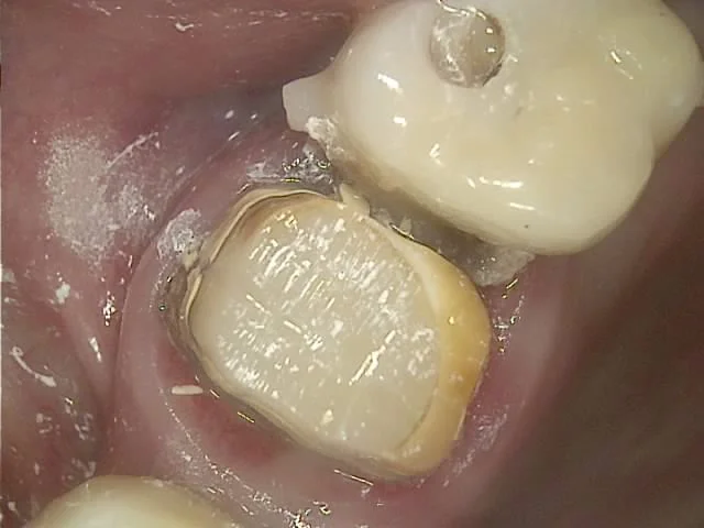 부적합 기존 크라운 음식물 저류