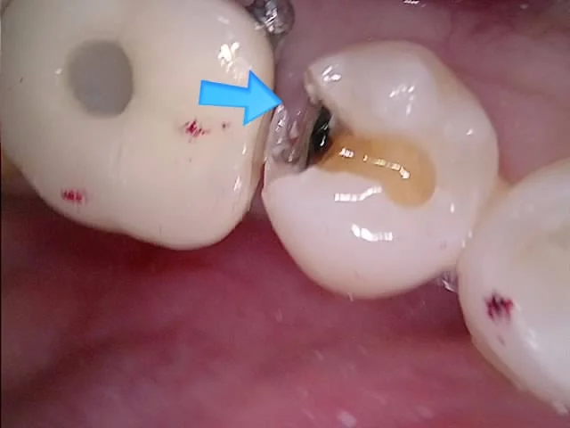 오른쪽 아래 충치 제거 후 치료 기록 임상 사진