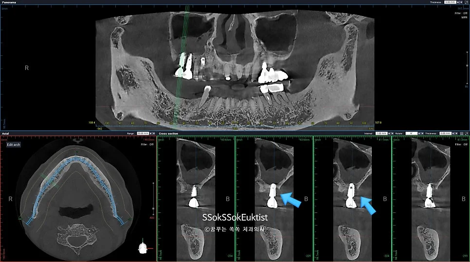 양측 임플란트 CBCT 골손실 진단