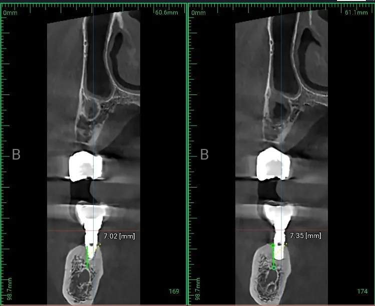 CBCT 3D 스캔 신경관 상방 잔존 골 높이 7mm 측정