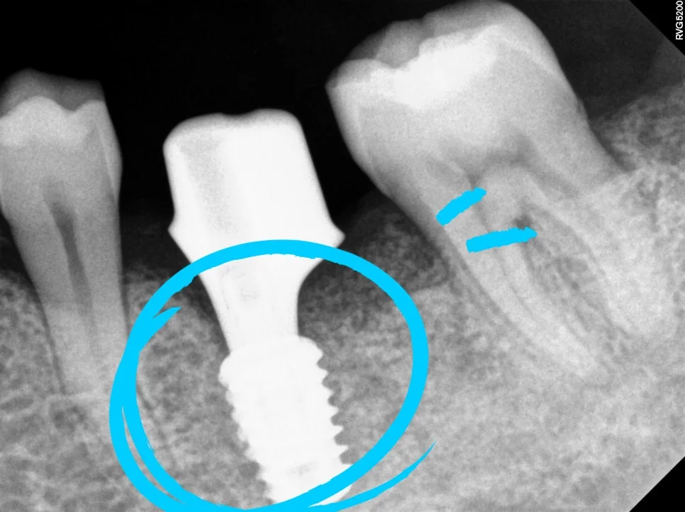 임플란트 식립 깊이 확인 CBCT 다각도