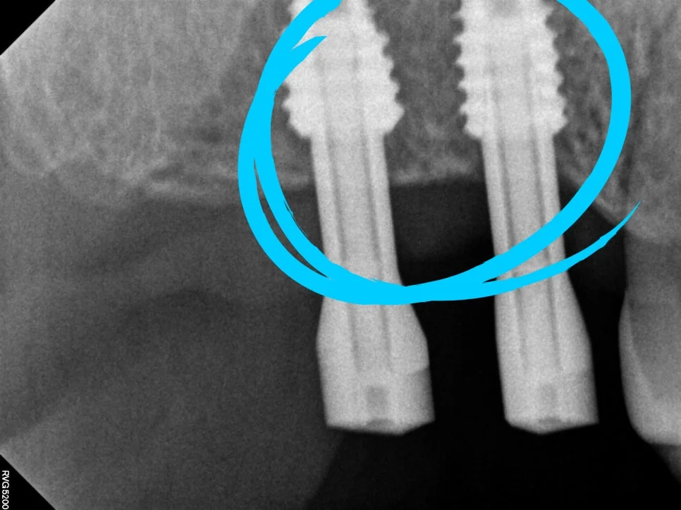 임플란트 식립 4개월 후 CBCT 뼈 유합 확인