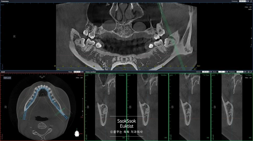 CBCT 왼쪽 하악 사랑니 신경관 인접 확인