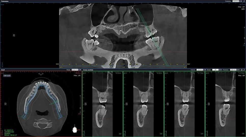 CBCT 좌측 하악 사랑니 신경관 인접 진단