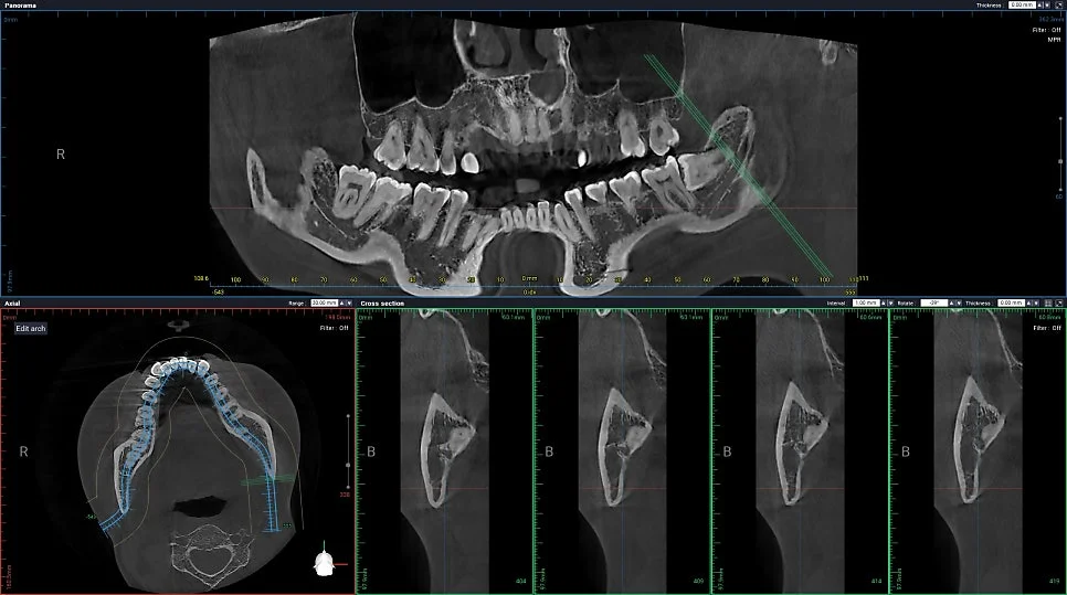CBCT 왼쪽 사랑니 신경관 인접 확인
