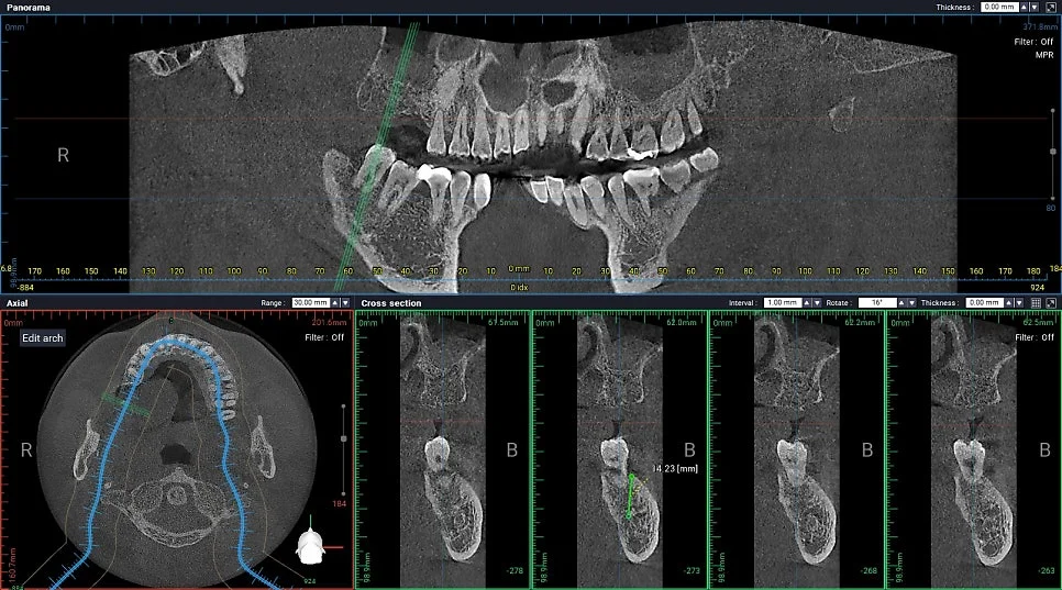 CBCT 어금니 주변 뼈 손실 횡단면